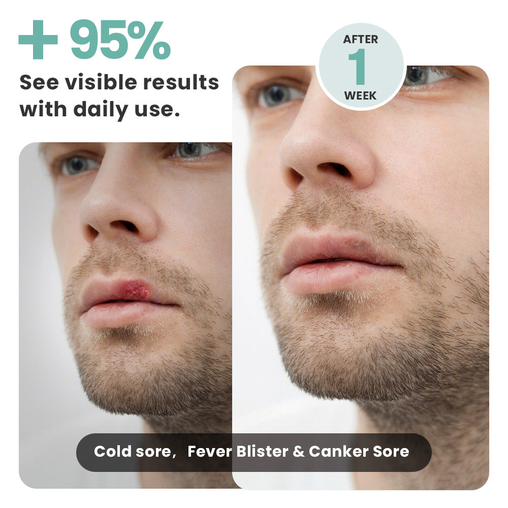 Cold sore treatment, fever blister relief, canker sore remedy: Before and after photos showing 95% improvement after one week of daily use.