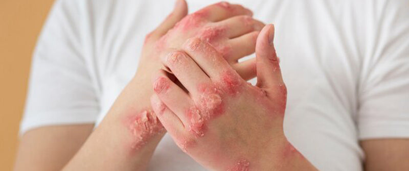 Treat Your Eczema with the Latest Harmless Effective Red Light Therapy Wand